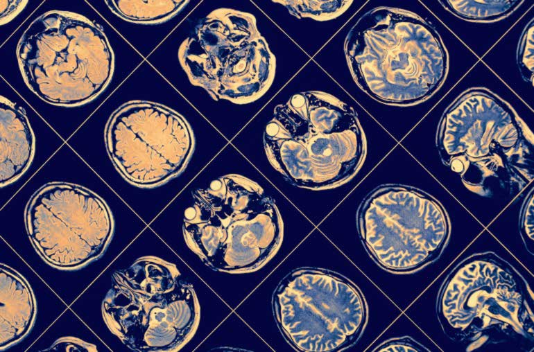 La teoría sobre el origen del Alzheimer