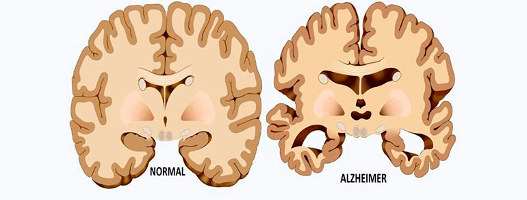 teoria-origen-alzheimer